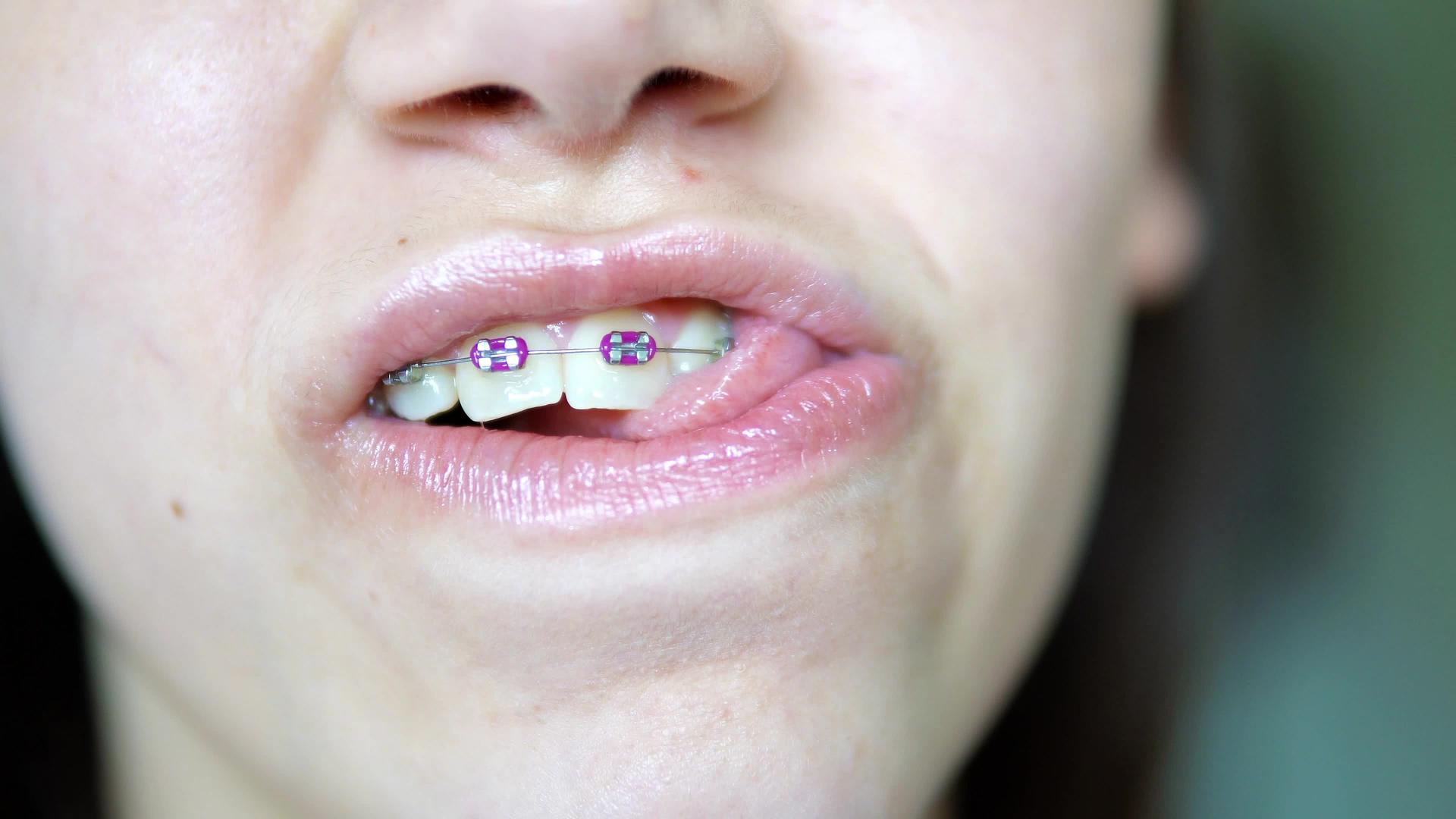美丽的年轻女子戴着牙套的肖像检查她的舌头视频的预览图