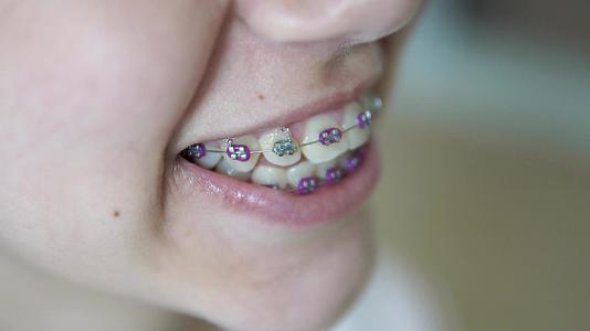 展示年轻女性矫形牙套的肖像视频的预览图