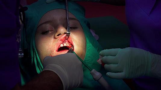 口腔手术用一个夹紧的缝合器把伤口缝在伤口上视频的预览图