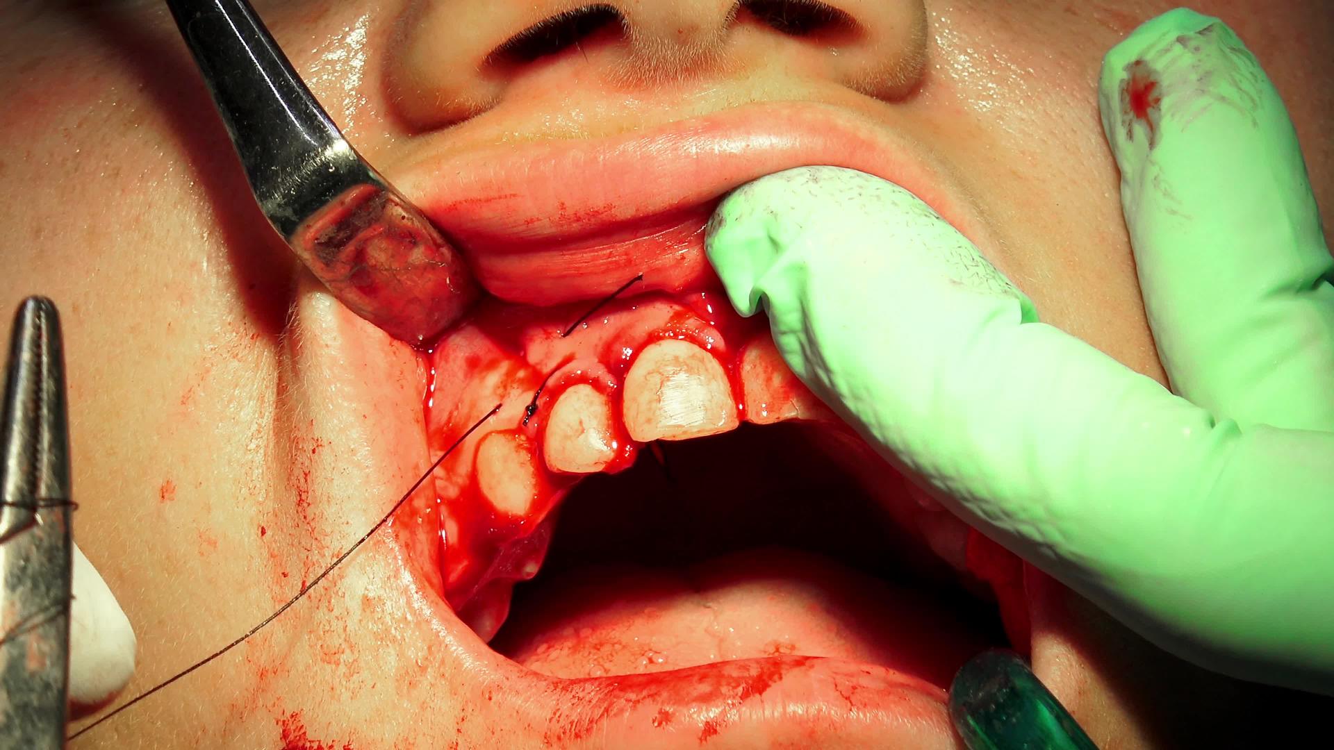口腔外科手术把伤口缝在伤口上视频的预览图