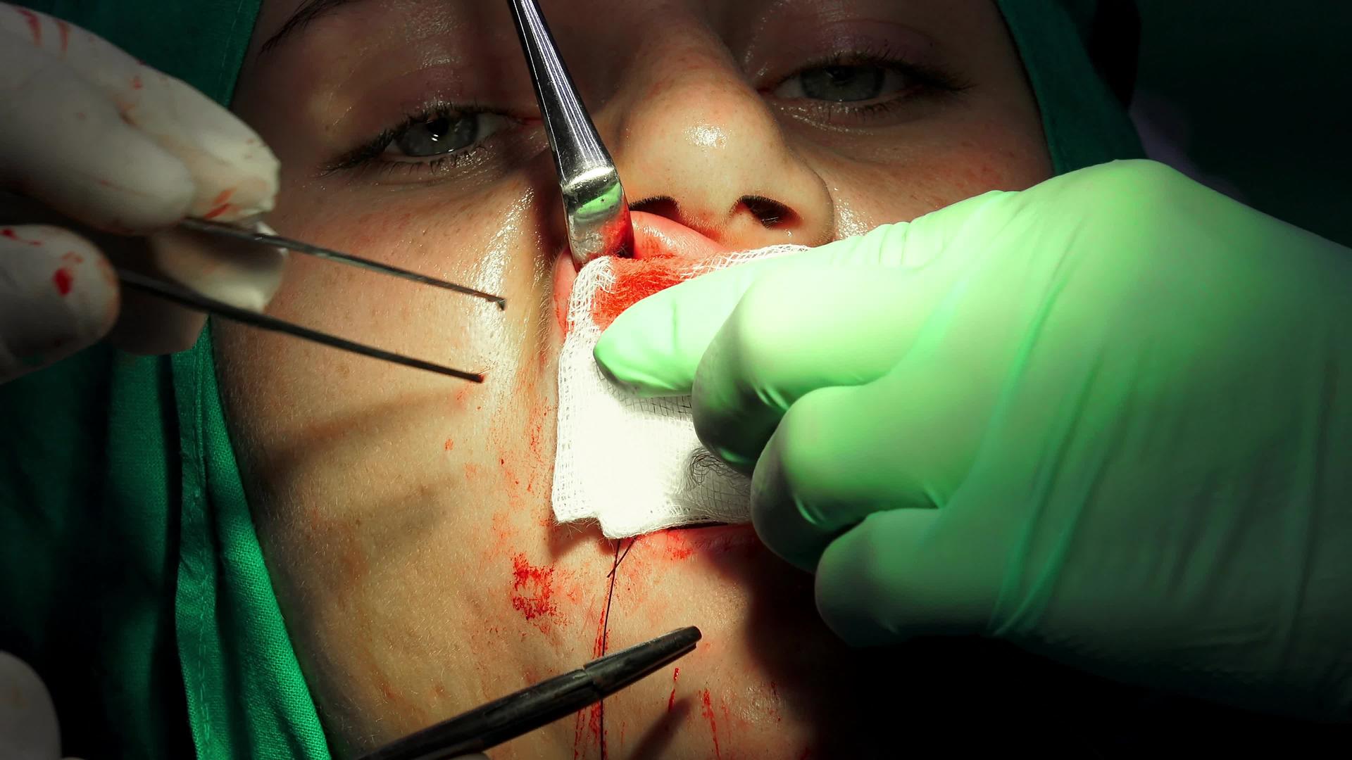 口腔外科用手术针缝合伤口视频的预览图
