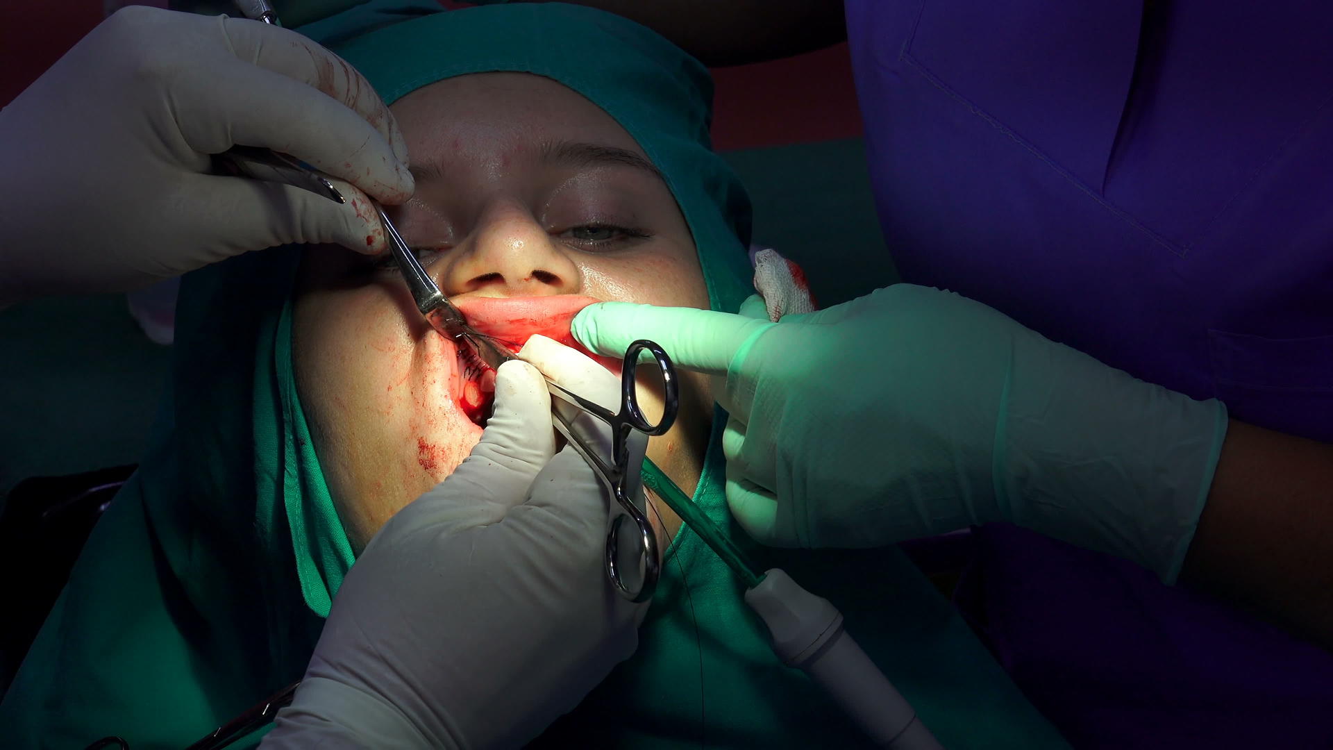 口腔外科用手术针缝合伤口视频的预览图