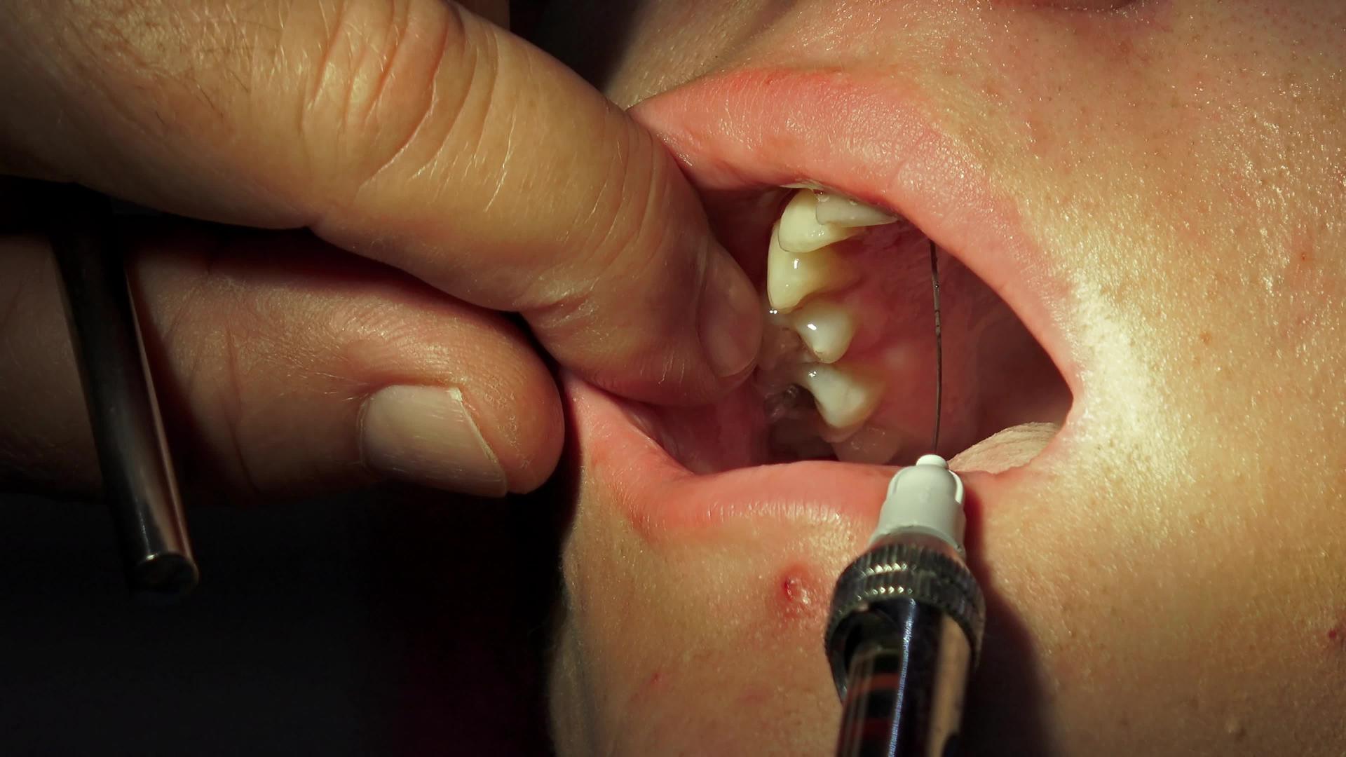 牙科手术闭合前牙科牙医进行麻醉注射视频的预览图