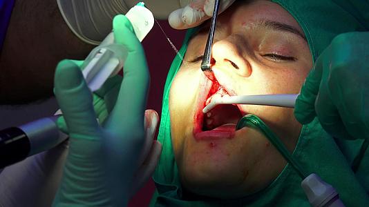 牙科植牙手术显示性口香糖手术闭合视频的预览图