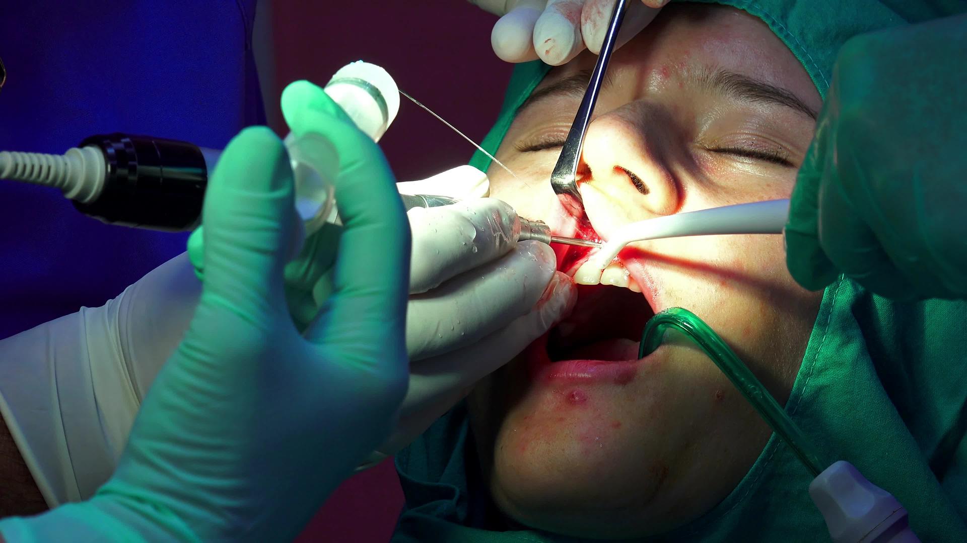 牙科植牙手术视频的预览图
