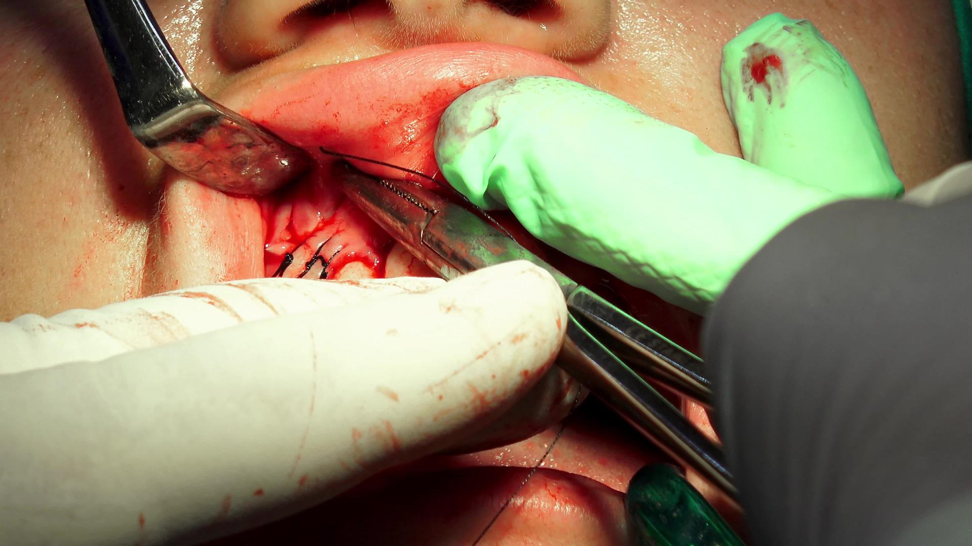 手术切除牙囊手术导致缝口愈合视频的预览图