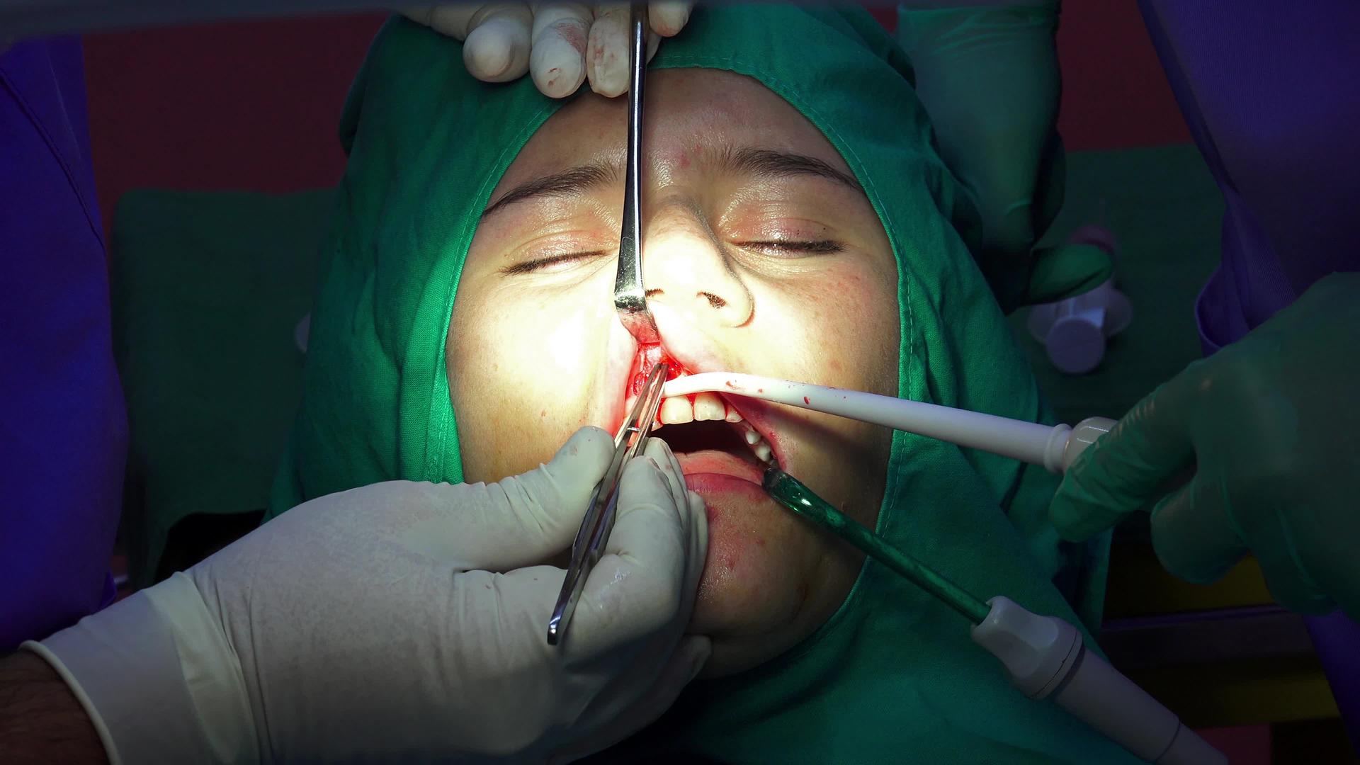 牙科植牙手术显示性口香糖手术闭合视频的预览图