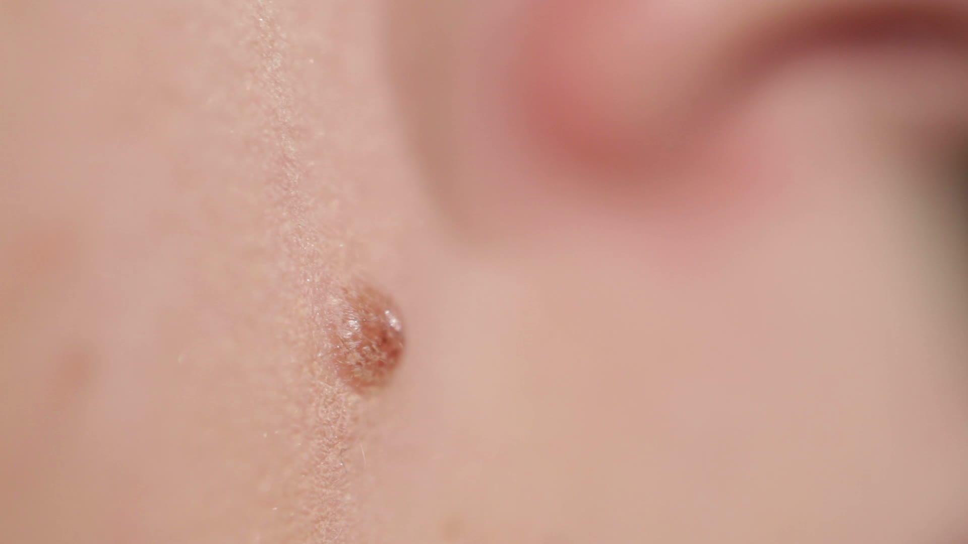 人体皮肤上的颗粒视频的预览图