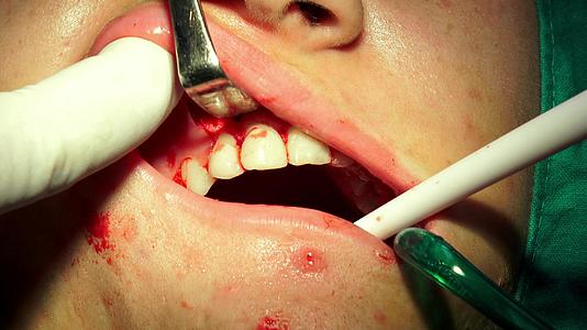 口香糖口腔手术室光谱视频的预览图