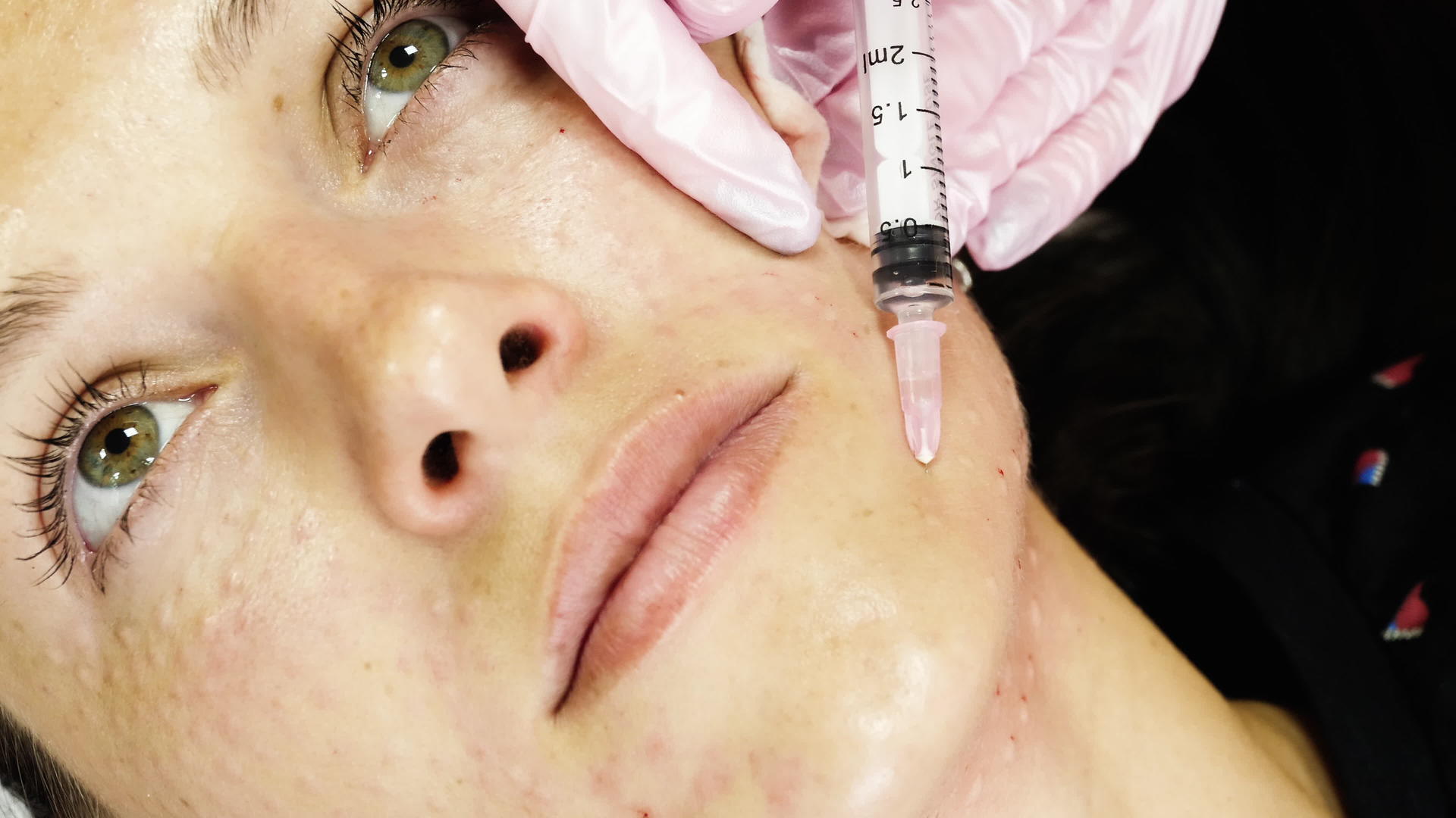年轻女性在面部手术中生物活化面部举重视频的预览图