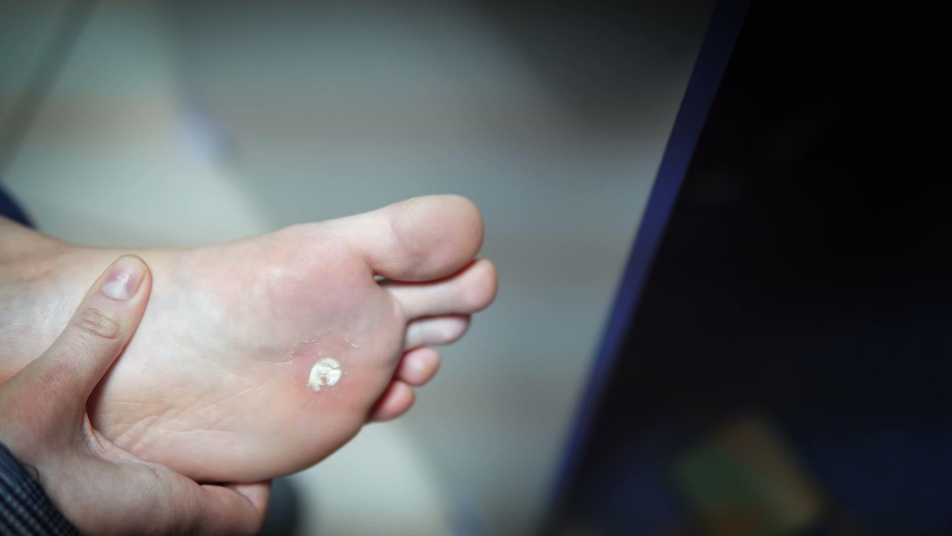 脚被细菌感染用低温疗法烧伤视频的预览图