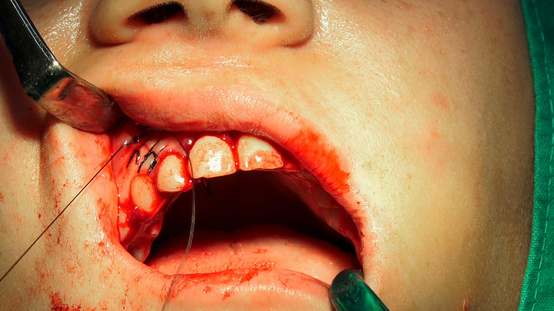 牙医在手术室用针架缝合伤口视频的预览图