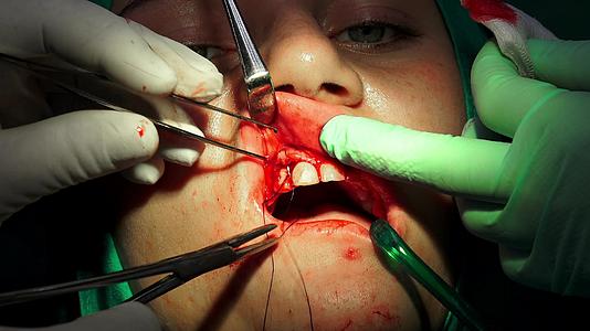 牙医在手术室用针架缝合伤口视频的预览图