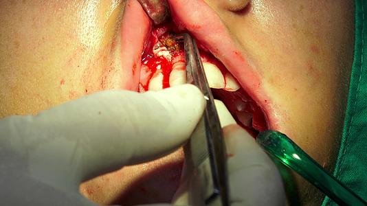 暗室手术室口腔外科手术光谱切片视频的预览图