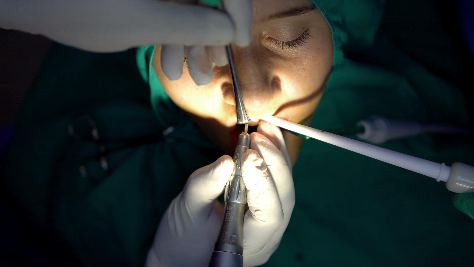口腔外科手术显光直视细胞黑暗手术室顶部有选择性焦点视频的预览图