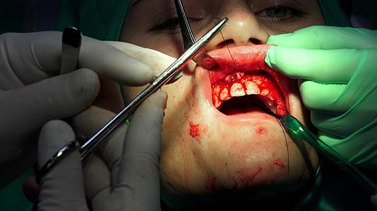 牙科手术切除细胞手术后的女性视频的预览图