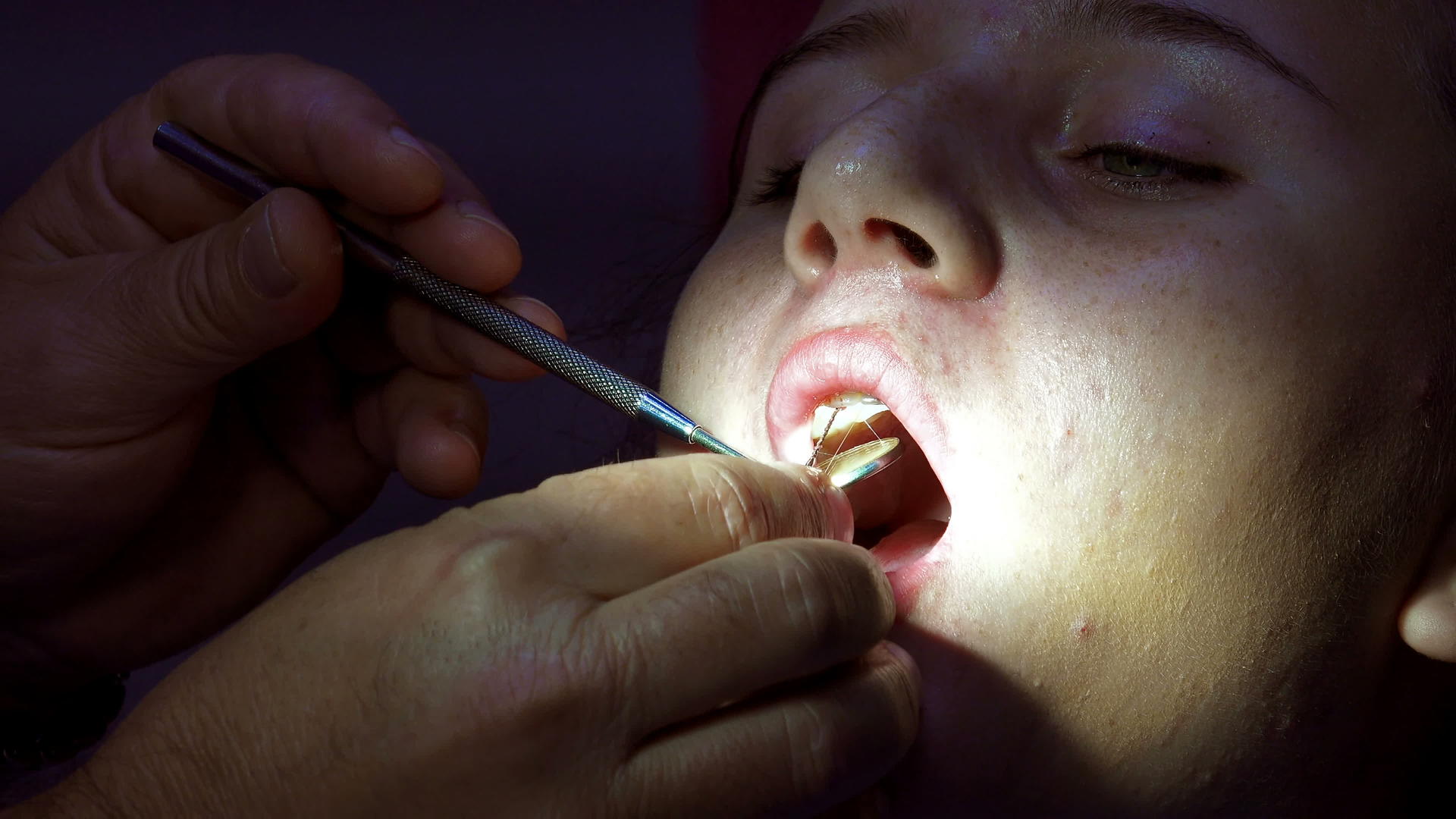 把牙科针放进病人的牙齿里视频的预览图