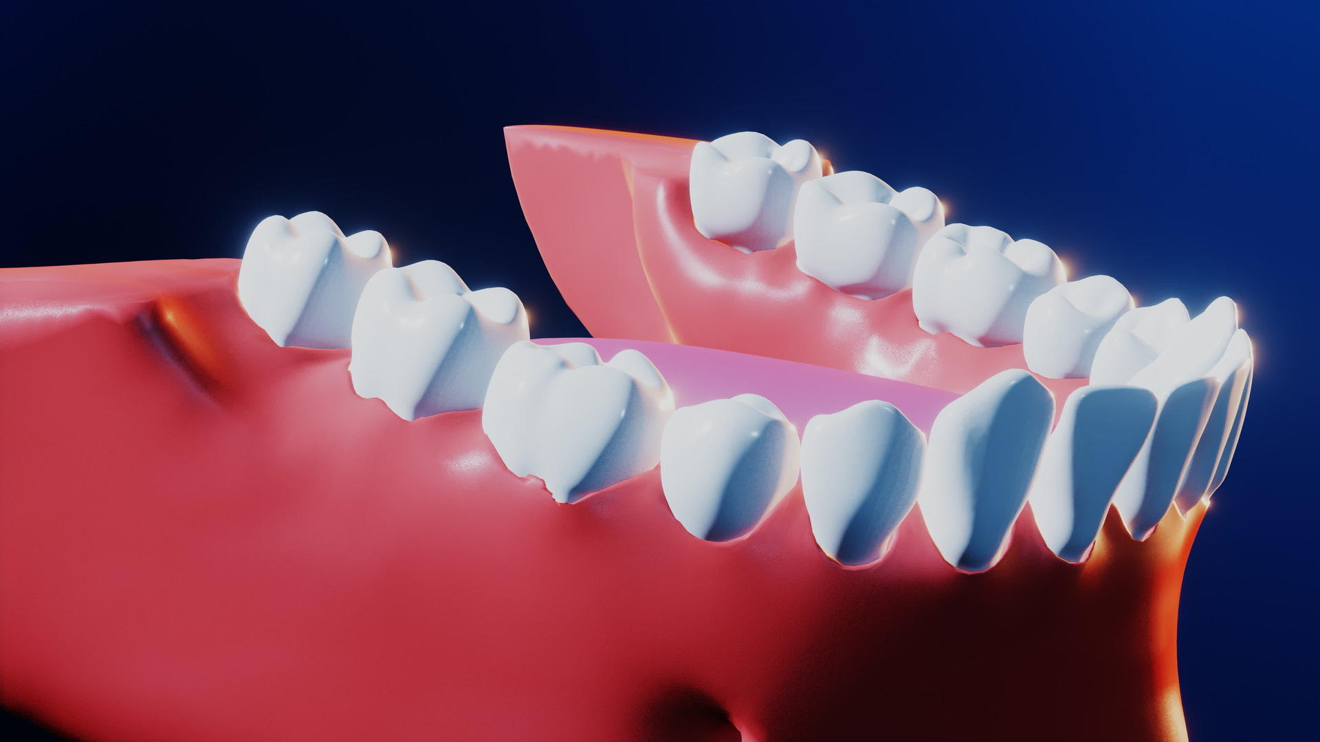 牙科植牙手术程序视频的预览图