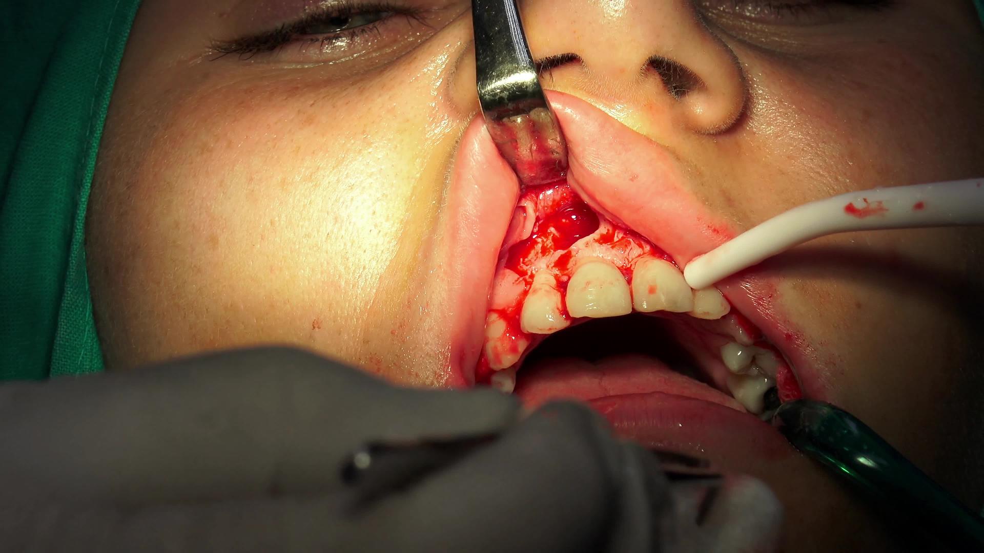 口腔手术手术脑切除手术室视频的预览图