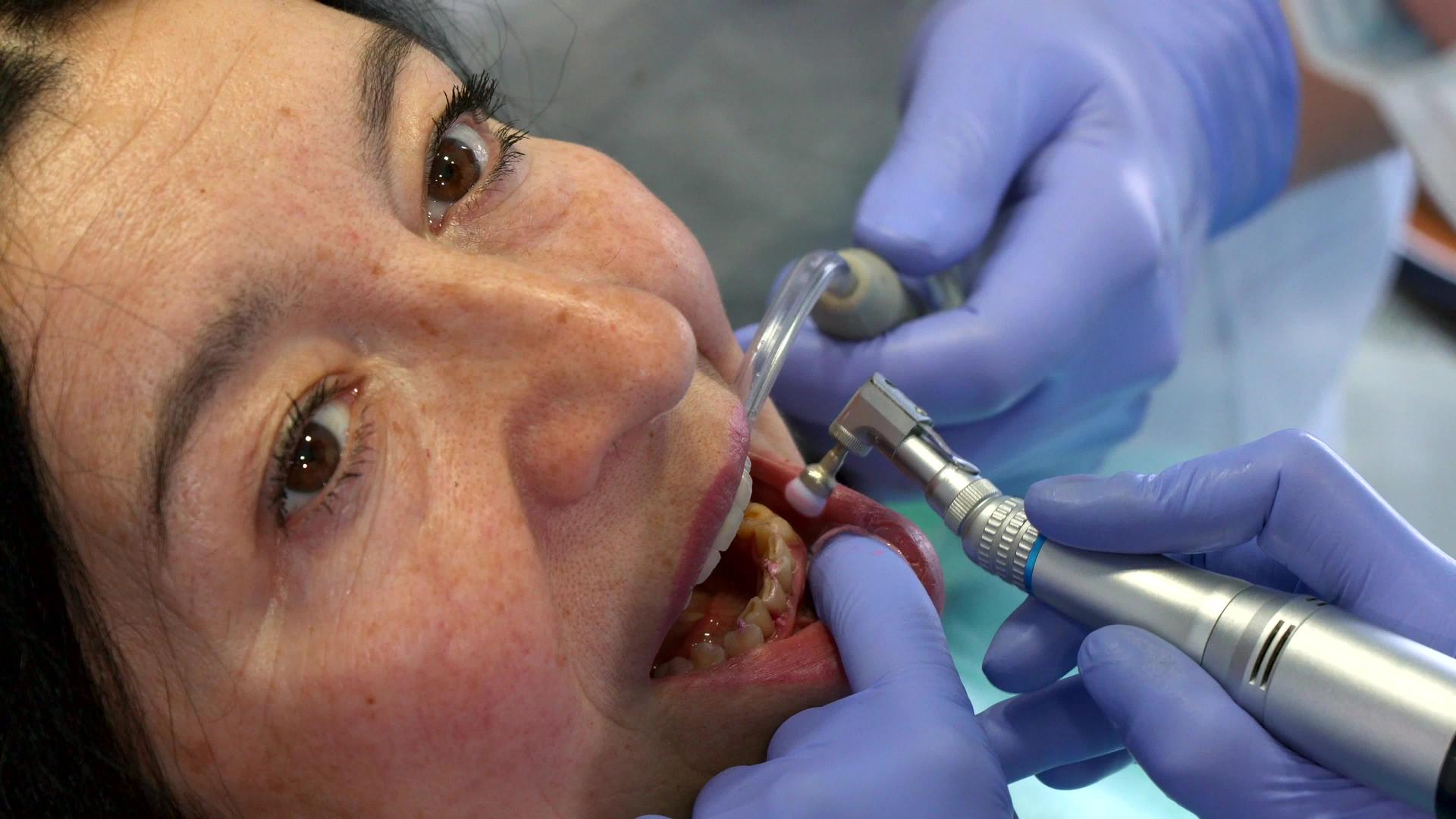 牙医更换预防杯的刷子视频的预览图