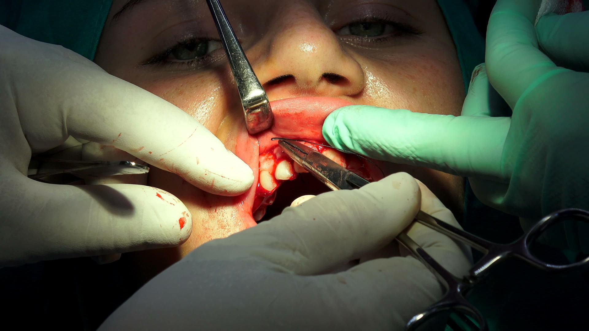 暗室口腔外科医生在暗室口腔手术视频的预览图