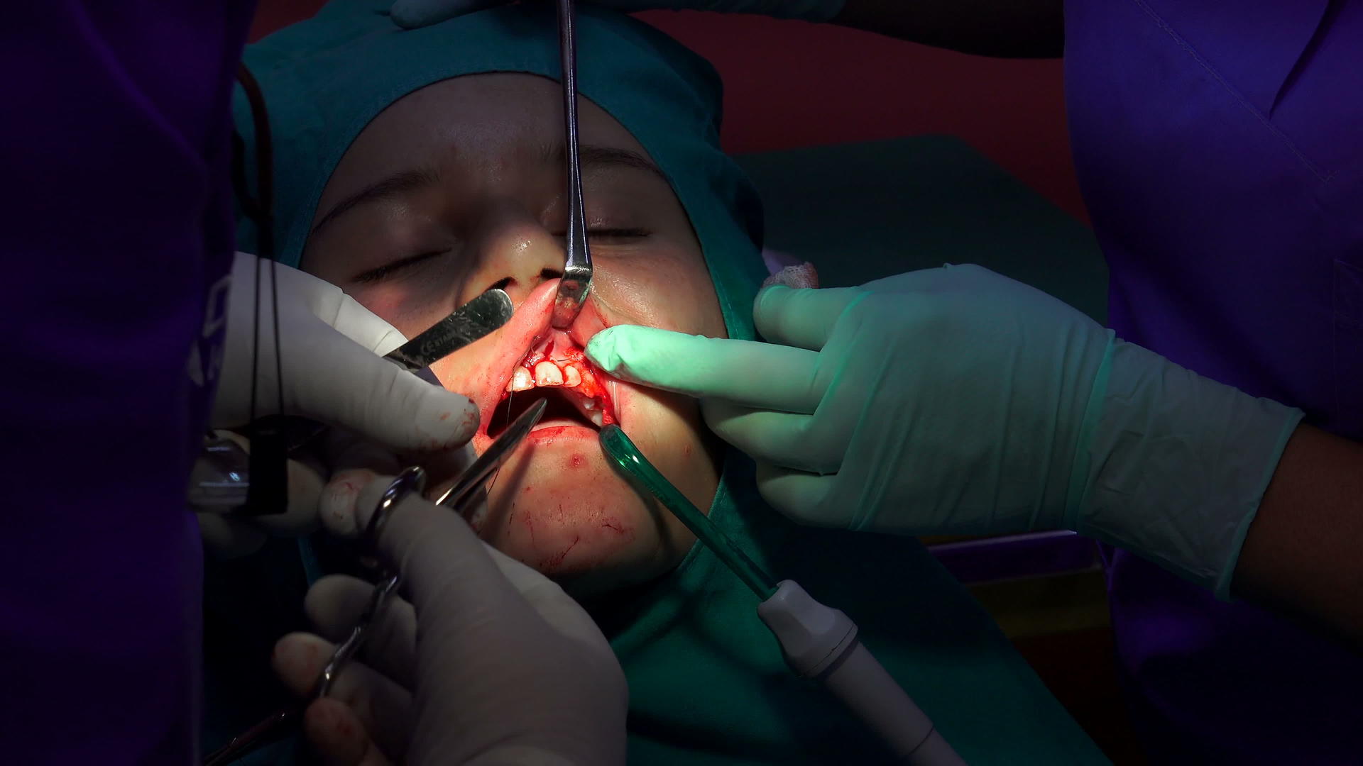 暗室口腔外科医生在暗室口腔手术视频的预览图