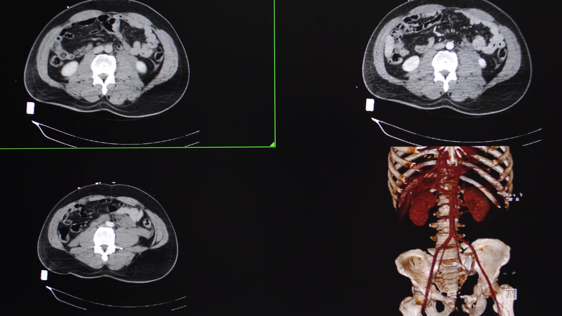 一名完全腹部受伤的男性患者视频的预览图