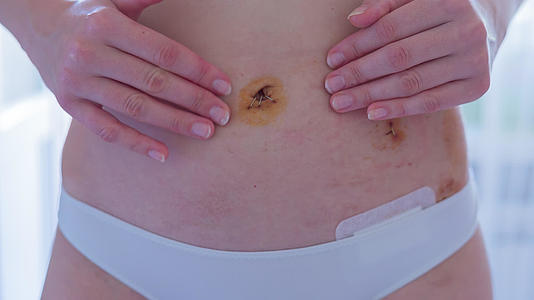 腹腔镜检查后年轻女性露出腹部视频的预览图