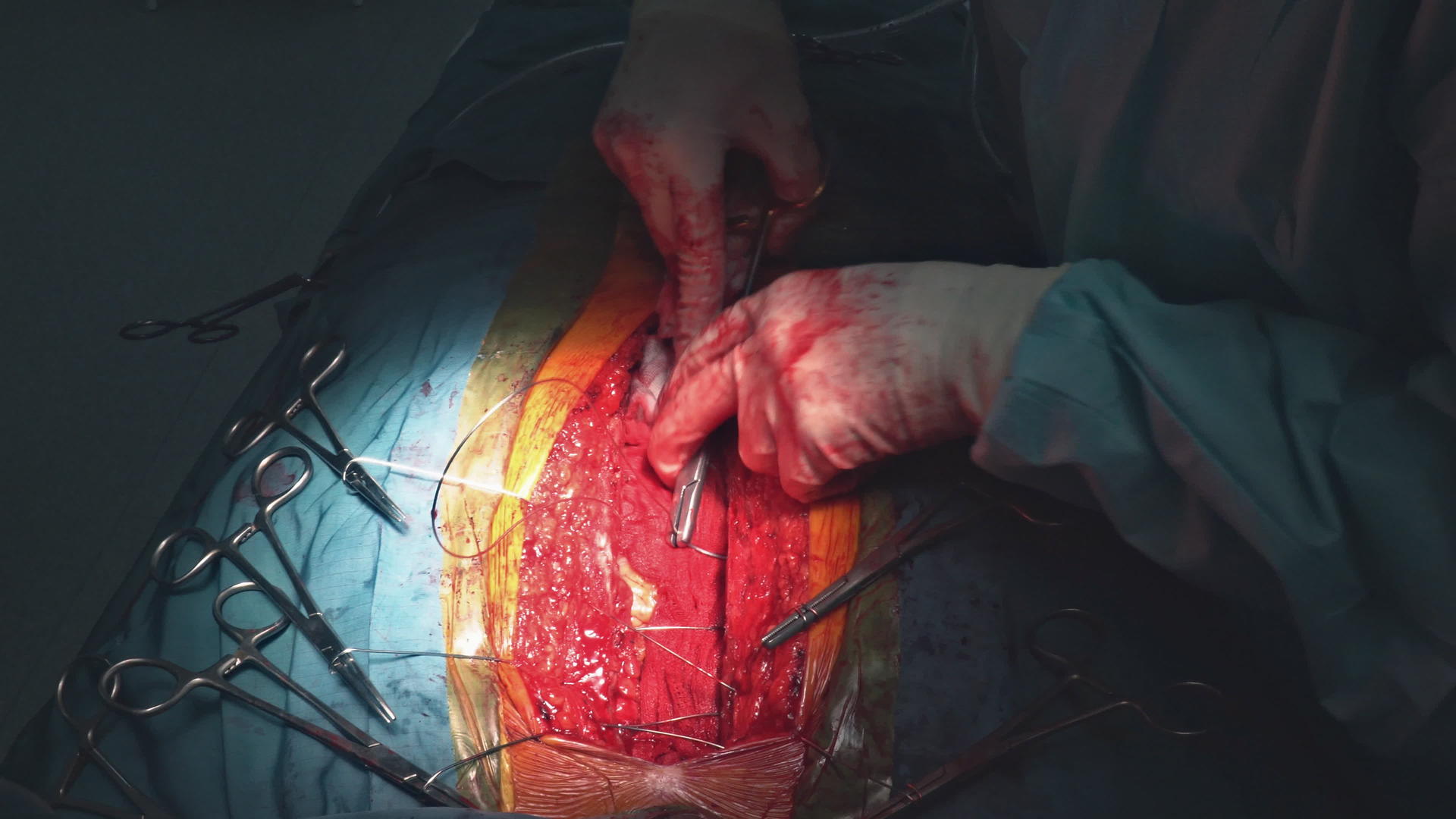 心脏手术后使用手术工具进行胸部闭合视频的预览图