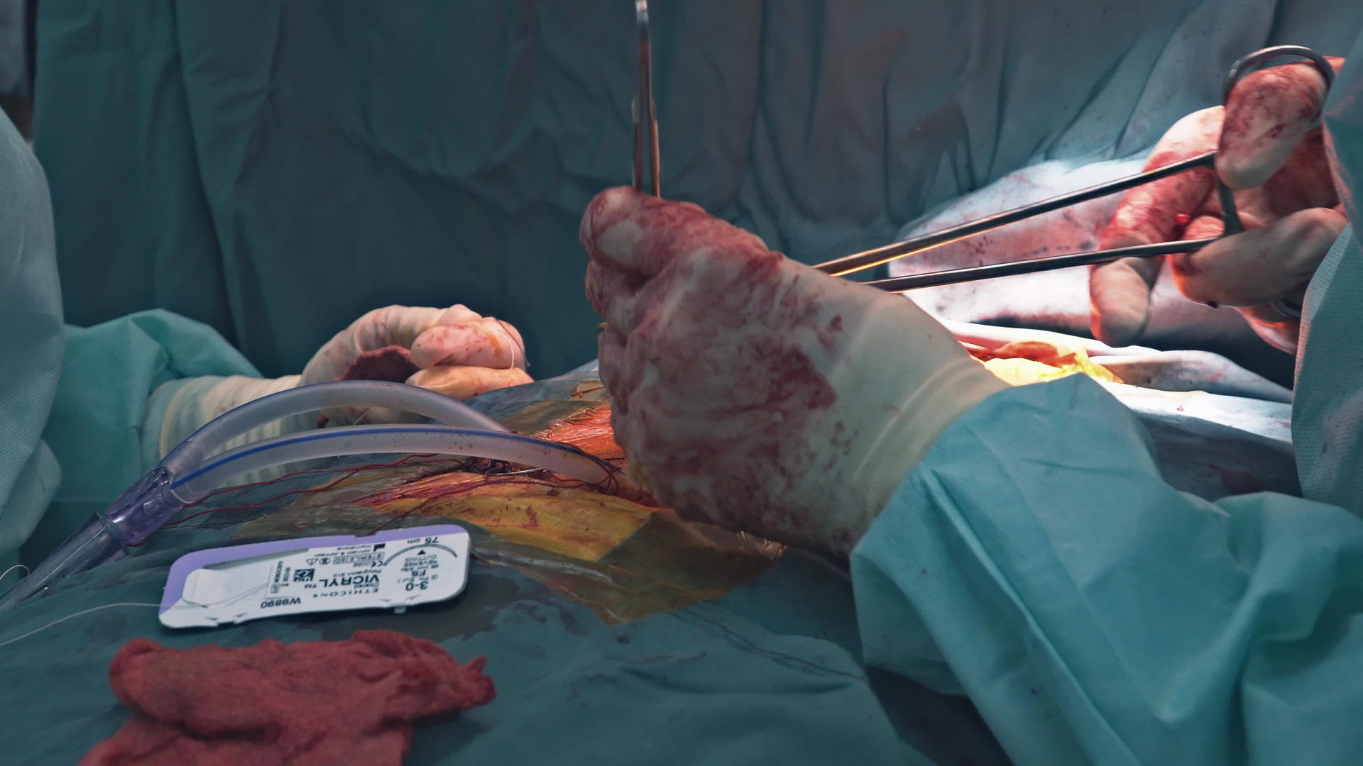 心脏手术后胸部紧闭拍摄结肠和结肠手术视频的预览图