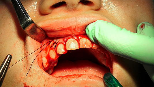 口腔细胞切除术后缝针视频的预览图
