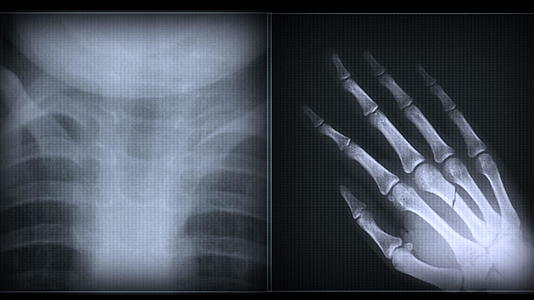 XX光人体骨骼视频的预览图