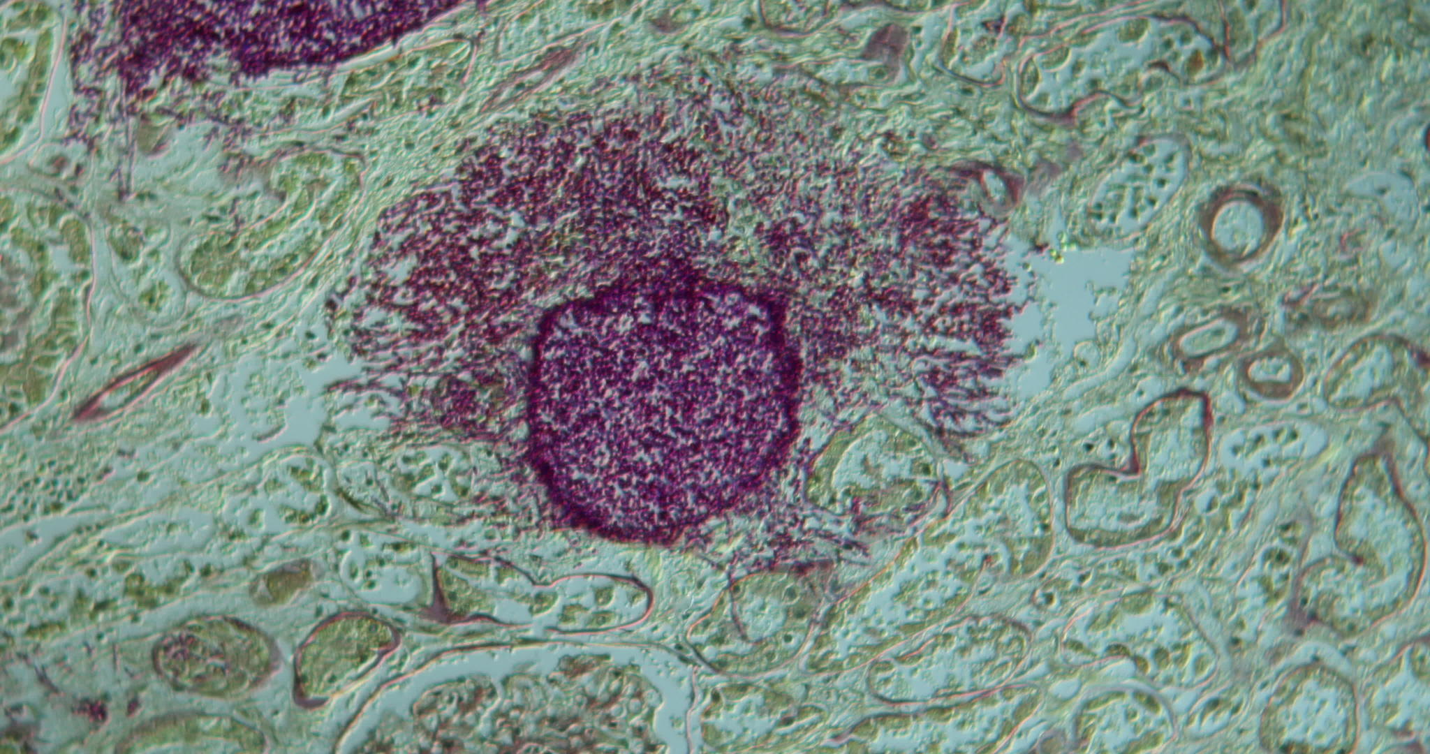 直肠酵母感染肾脏视频的预览图