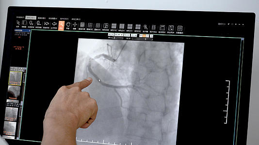 8k病人血管造影手术前后对比视频的预览图