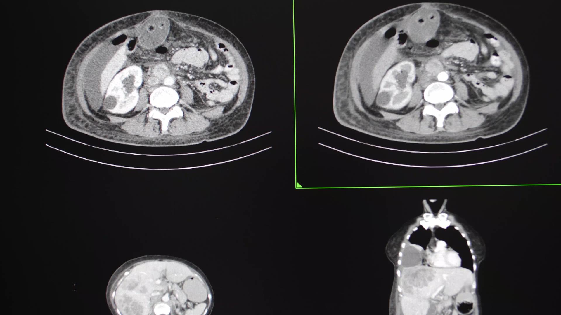 女性患者的胸部和腹部Ct扫描视频的预览图