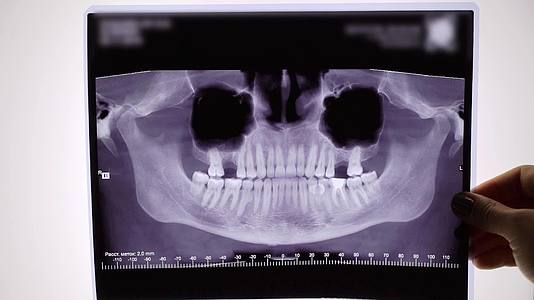 牙齿和下巴的X光胶片视频的预览图