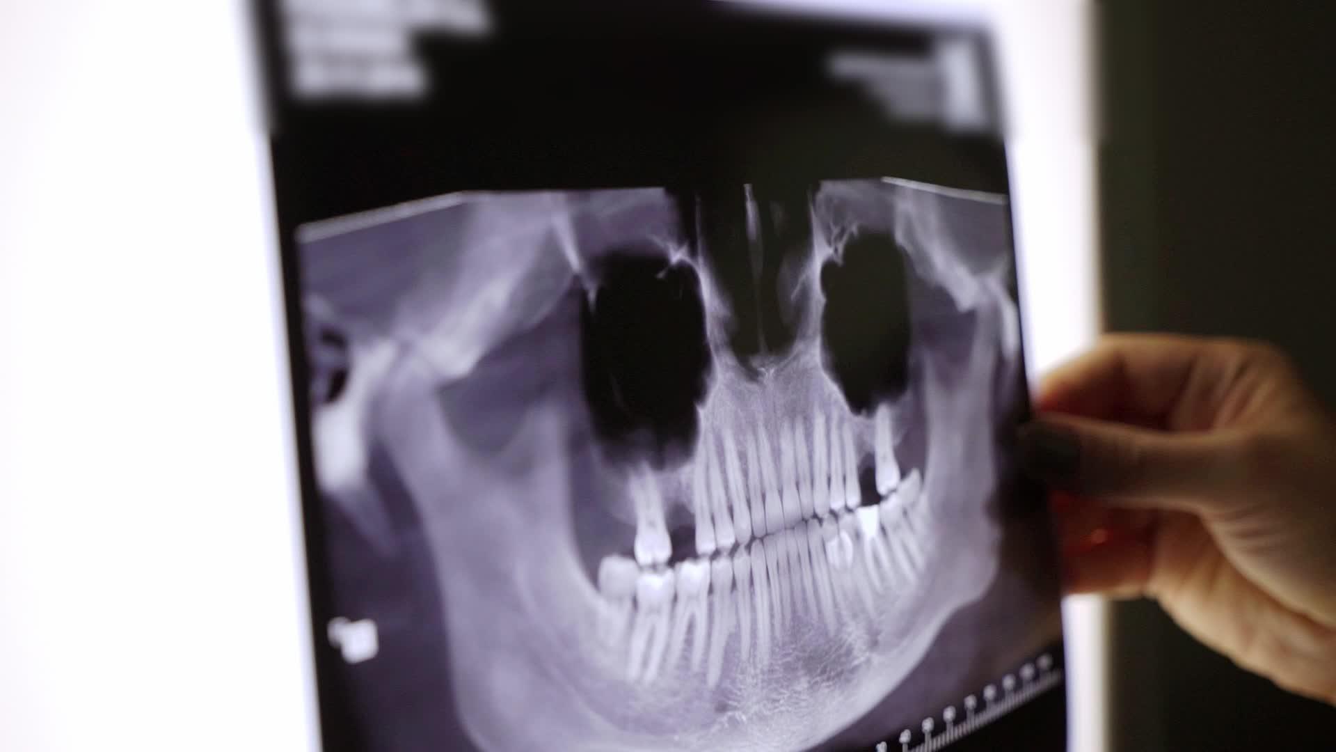 牙齿和下巴的X光胶片视频的预览图