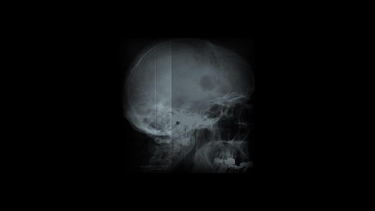 X射线动画的黑色背景视频的预览图