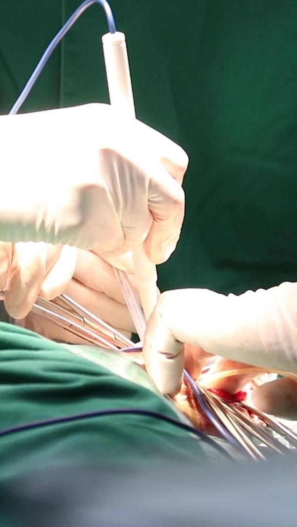 实拍医院手术室医生做手术场景视频的预览图