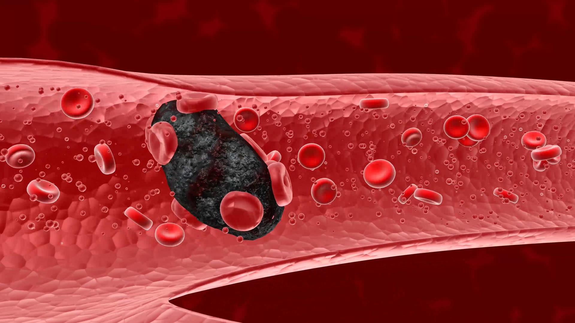 血液垃圾形成的血栓脱落后堵塞血管视频的预览图