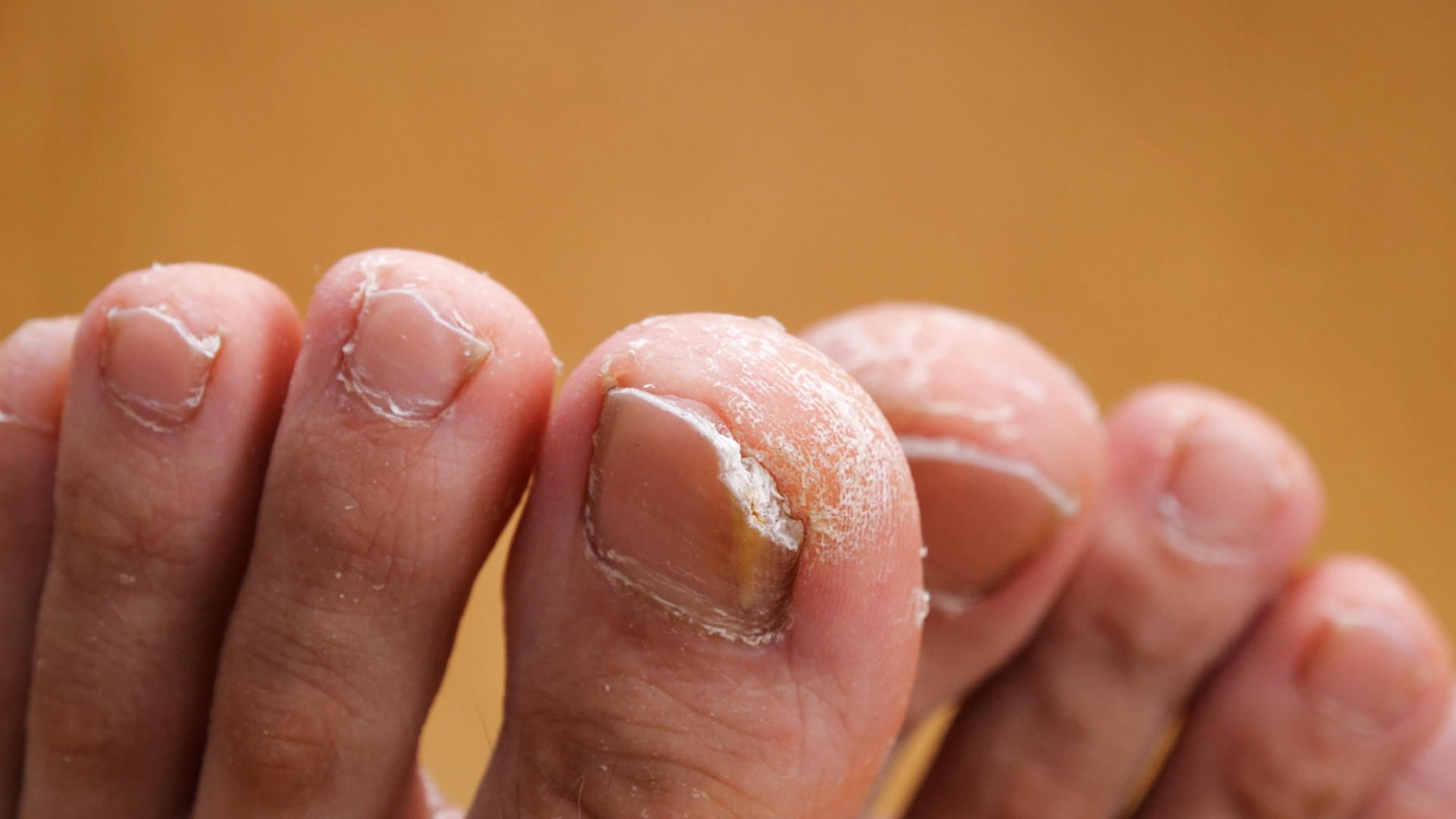 4K脚气灰指甲皮肤病皮肤干裂视频的预览图